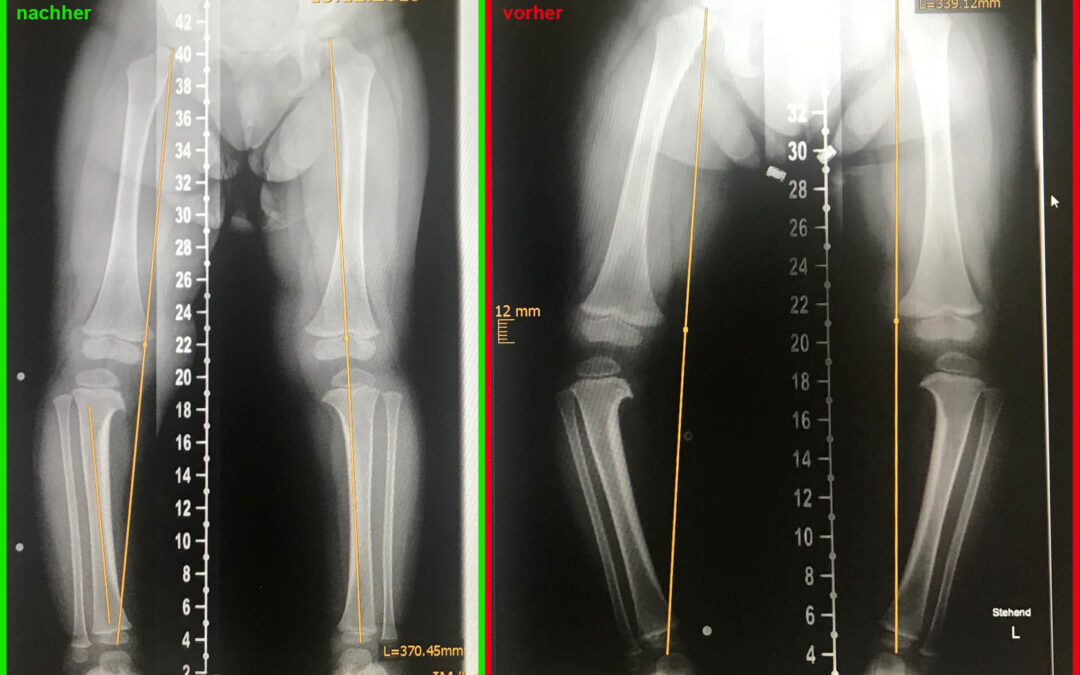 Röntgenbilder Tibia vara im Zeitraum von 6 Monaten