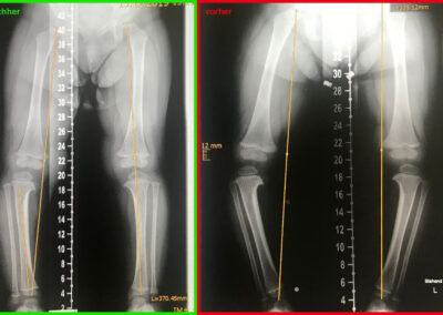 Röntgenbilder Tibia vara im Zeitraum von 6 Monaten