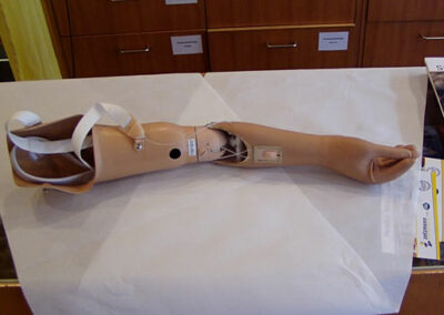 Diese Oberarm-Prothese hat ein Zugsystem für die Oberarmbeugung und ein Zugsystem für die separate Daumenbewegung.