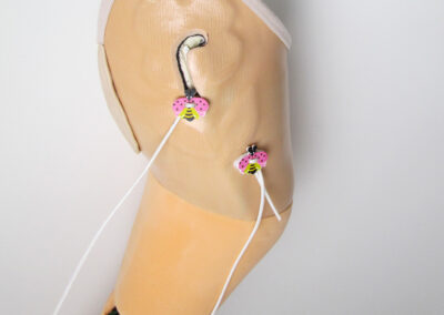 Oberschenkel-Prothese für ein Mädchen, mit Relief-Gestaltung und kleinen Accessoires