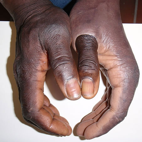 Prothesen für die Hand